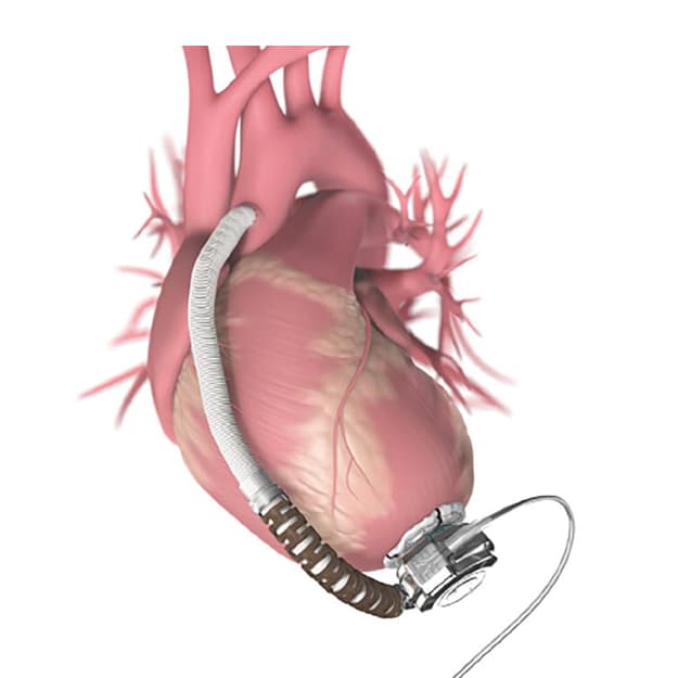 lvad