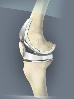 artificial knee